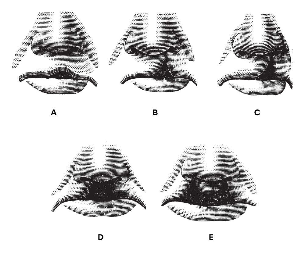 Types of Cleft Palate